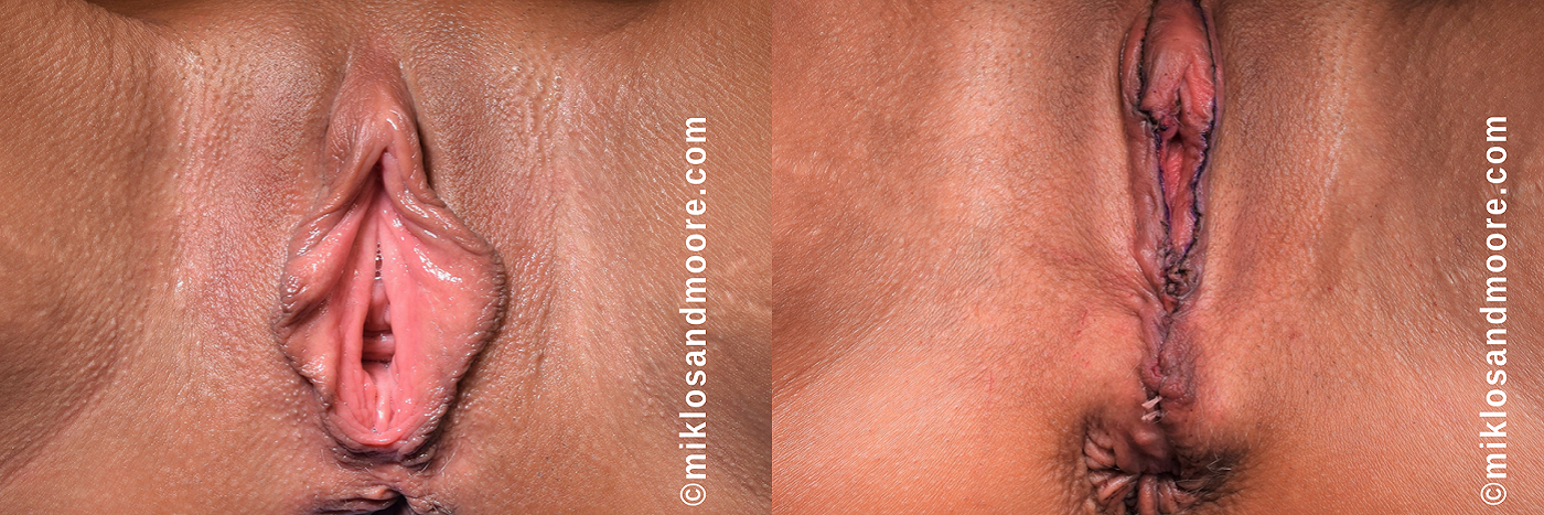 Labiaplasty Before & After Gallery | Drs. Miklos & Moore Labiaplasty before and after photos by Drs. Miklos and Moore featuring correction of enlarged labia with refined surgical contour.