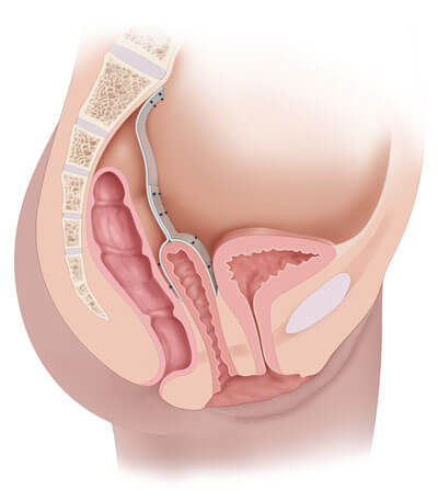 Laparoscopic-Hyteropexy