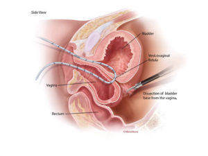 Laparoscopic dissection of the bladder from the vagina during vesicovaginal fistula repair