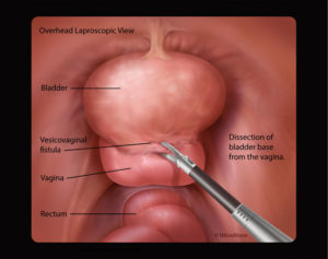 Overhead laparoscopic view of bladder and vagina dissection during VVF repair