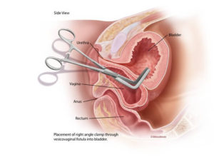 Locating a vesicovaginal fistula during VVF repair