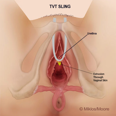 MESH EXTRUSION THROUGH VAGINAL SKIN