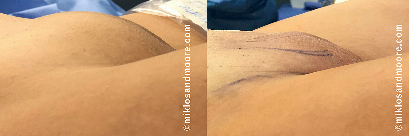 Cuantas sesiones de laser se necesitan para el pubis