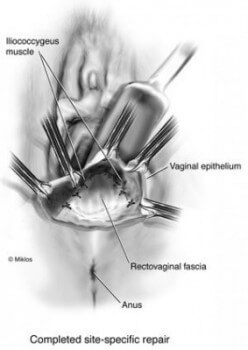 RECTOVAGINAL FASCIA REPAIR