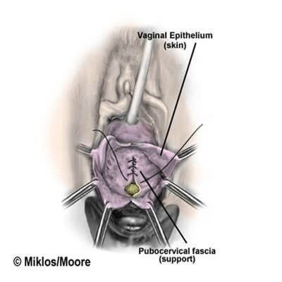 Repairing the pubocervical fascia