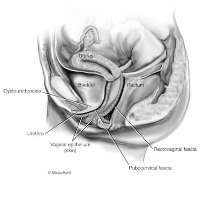 Sagging Urethra