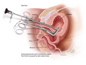 Stent placement through a vesicovaginal fistula during VVF surgery