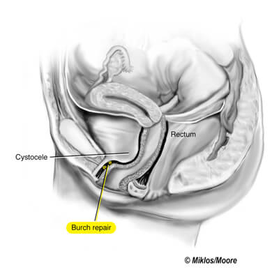 Supported Urethra after a Burch (side view)