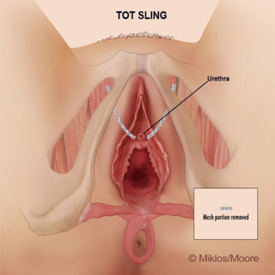 AVERAGE TOT SLING REMOVAL