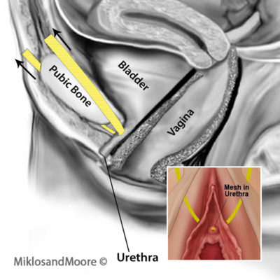 TOT SLING IN URETHRA