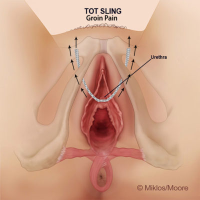 TOT SLING: GROIN PAIN/DIFFICULTY WALKING