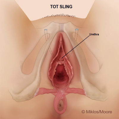 TOT SLING: REMOVAL OF MESH TO RELIEVE TENSION/PAIN