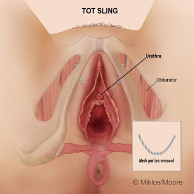 DRS. MIKLOS AND MOORE TOT REMOVAL FOR VAGINAL PAIN