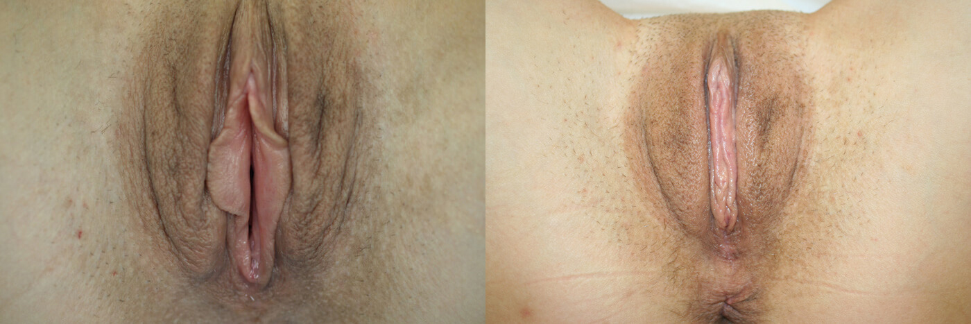 Vaginal Rejuvenation Orlando