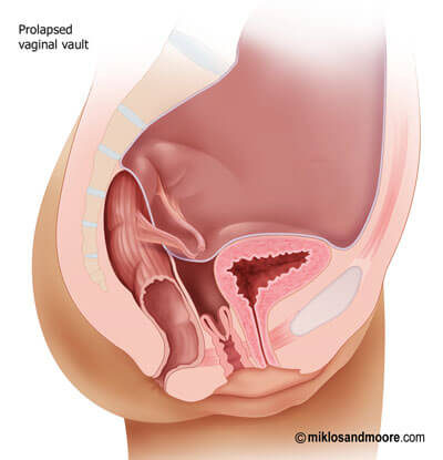 Vaginal Vault Prolapse