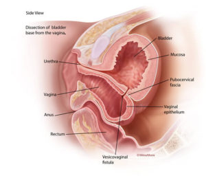 Vesicovaginal fistula between the bladder and vagina