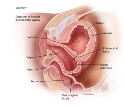 Vesicovaginal fistula