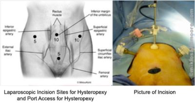 hysteropexy-incision