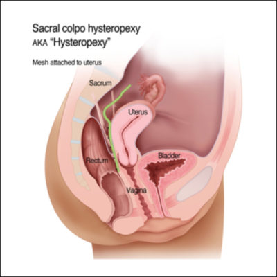 hysteropexy-mesh-uterus