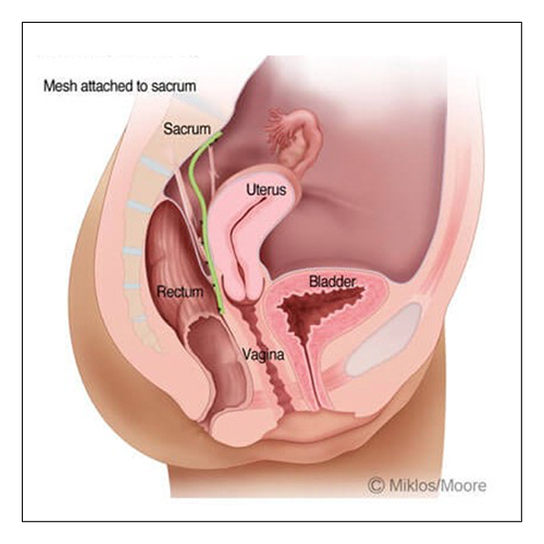 HYSTEROPEXY UTERINE SUPPORT