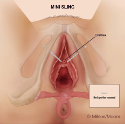 mini-sling-correction-urination