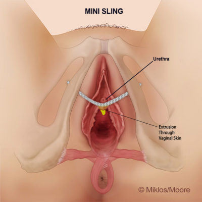 mini-sling-extrusion