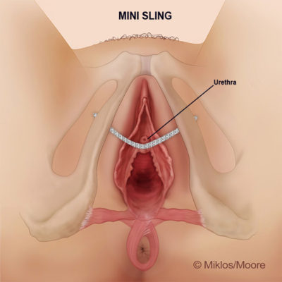 mini sling normal