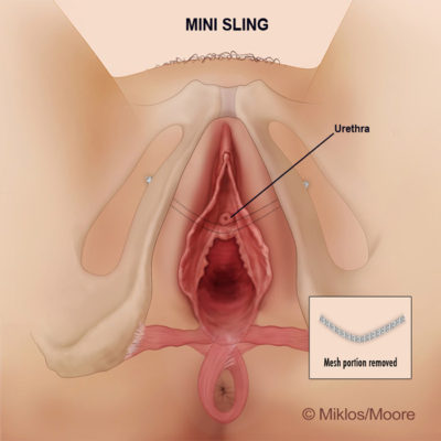 mini-sling-removal-vaginal-