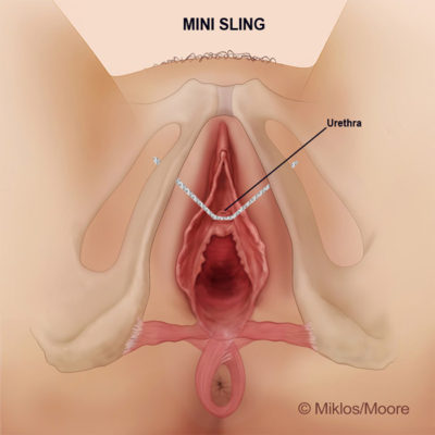 mini-sling-tension-urination