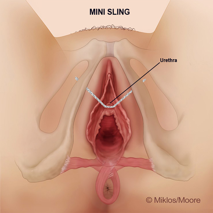 Management Of Vaginal Discharge In Primary Care