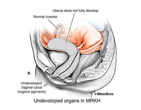 mrkh - underdeveloped