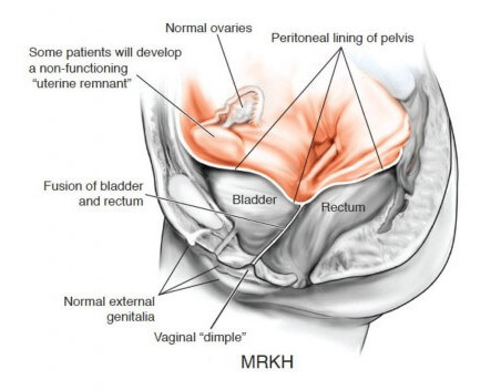 mrkh