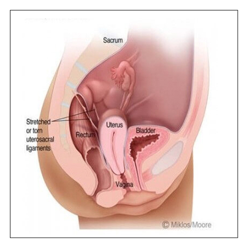 PROLAPSED UTERUS & VAGINAL VAULT