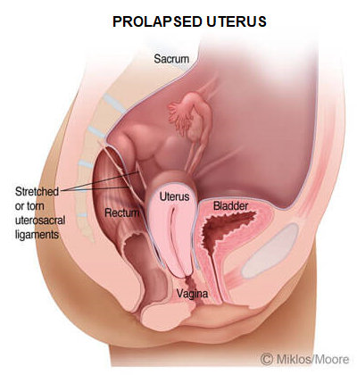 Prolapsed Uterus