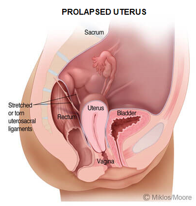 Pelvic Organ Prolapse Atlanta, Uterine Prolapse