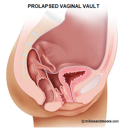 Prolapsed Vaginal Vault