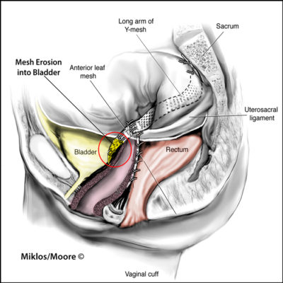 MESH EROSION   BLADDER