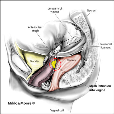 sacrocolpopexy-mesh-extrusion-vagina