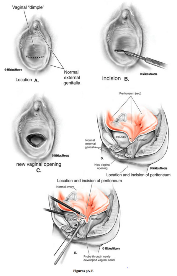 mrkh- surgical procedure