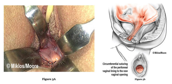 mrkh - surgical procedure fig5