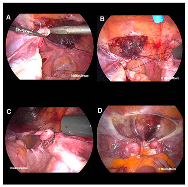 surgical-procedure-sutures