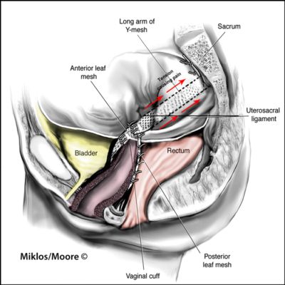 TENSION VAGINAL PAIN