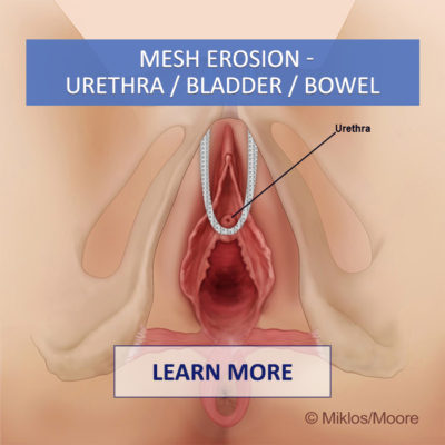 mesh erosion bladder