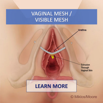 vaginal-mesh