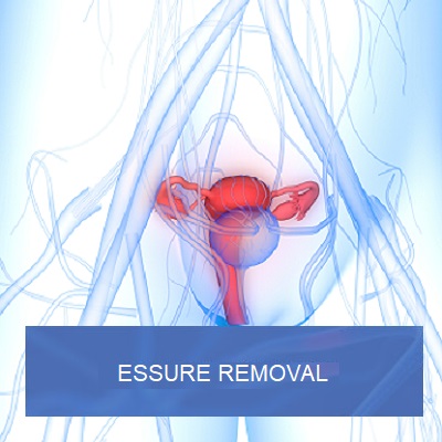 Essure Removal