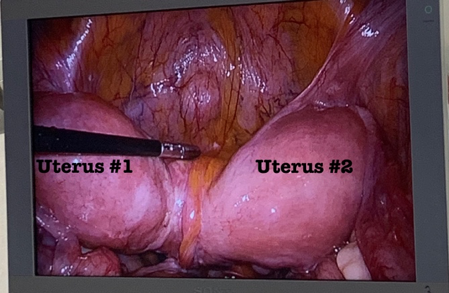 Figure 3: Laparoscopic View of Uterus Didelphy (Two Uteruses) 