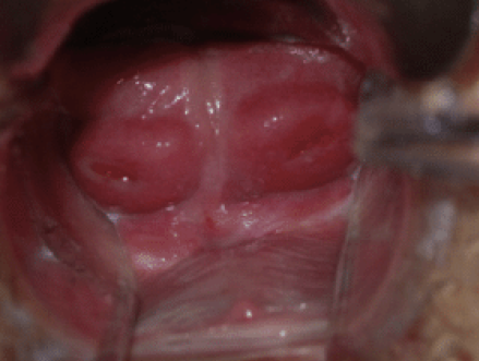 Figure 2: Two Cervixes
