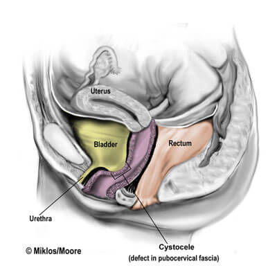 cystocele_paravaginal