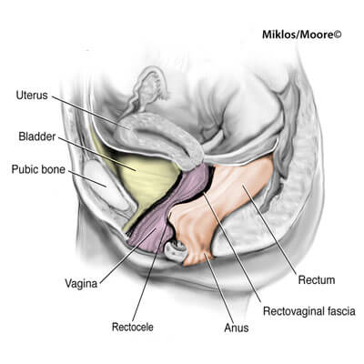 Anterior vaginal prolapse (cystocele) - Diagnosis and treatment - Mayo  Clinic
