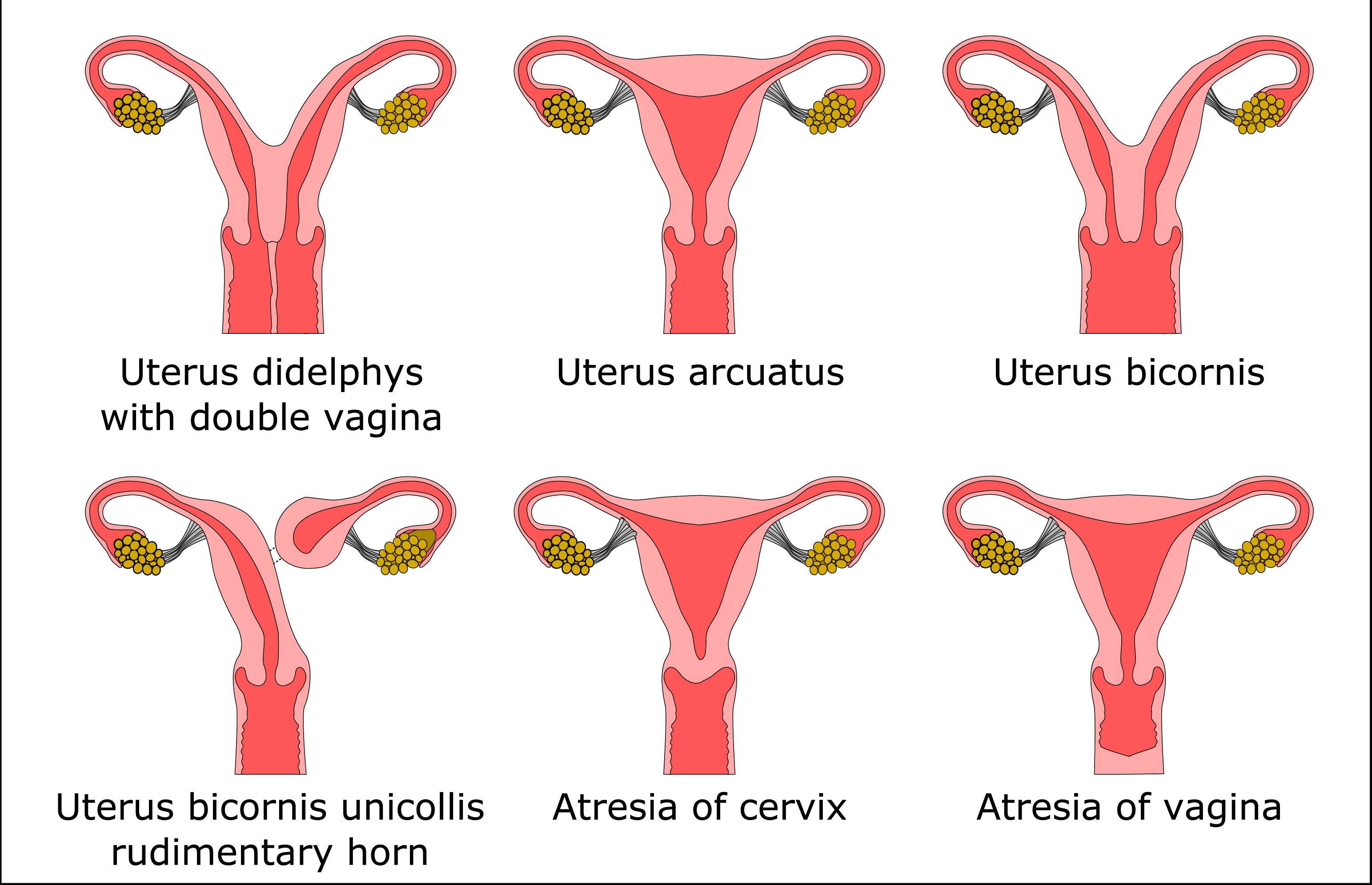 Hysteropexy Atlanta, Vaginal Prolapse